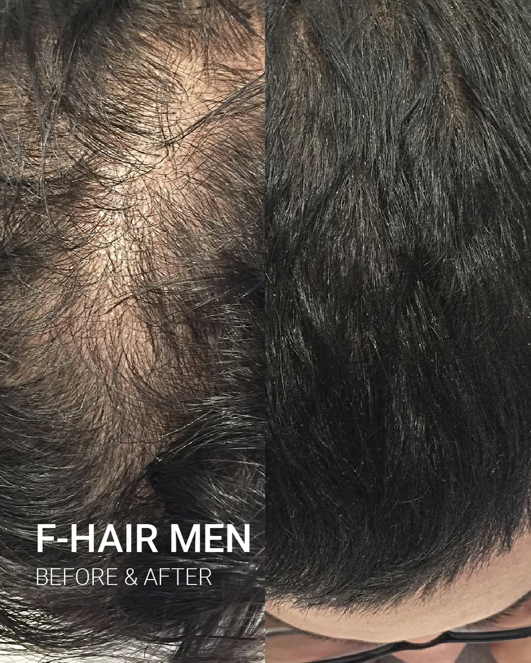 F-HAIR MEN Before After